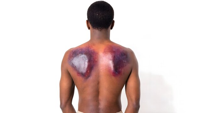 Close-up of large shoulder and upper back hematoma from blunt trauma. Clinical photo of severe male muscle bruising, isolated on white background.