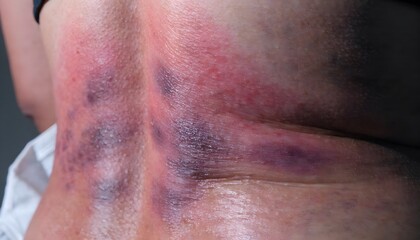 Fototapeta premium Medical photography of lumbar muscle strain with external redness and bruising on lower back. Close-up clinical view of spine area injury and inflammation.