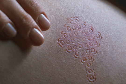 Closeup of a patterned imprint on human skin with a hand nearby