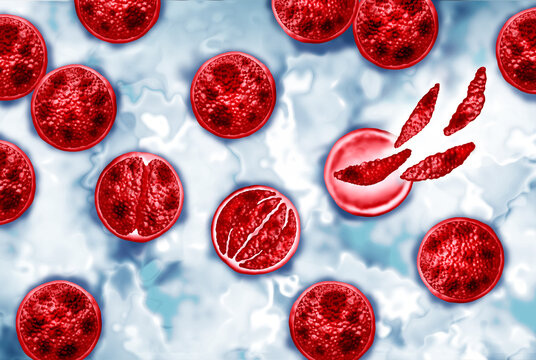 Cyclosporiasis growth with Cyclospora sporozoite as an outbreak of a foodborne parasitic illness caused by cayetanensis  with contaminated food or water resulting in explosive diarrhea and digestive i