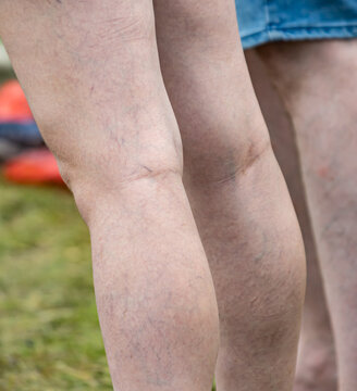 Close-up of human legs with visible veins