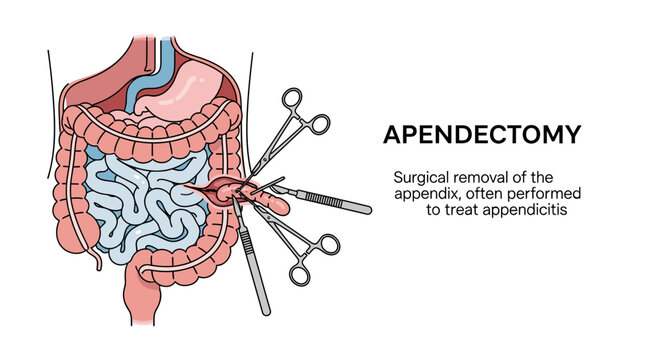 Medical illustration of an appendectomy procedure, showing surgical instruments removing the appendix from the human digestive system, with explanatory text.