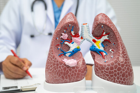 Pneumonia, lung cancer, Asian doctor with human lung model.