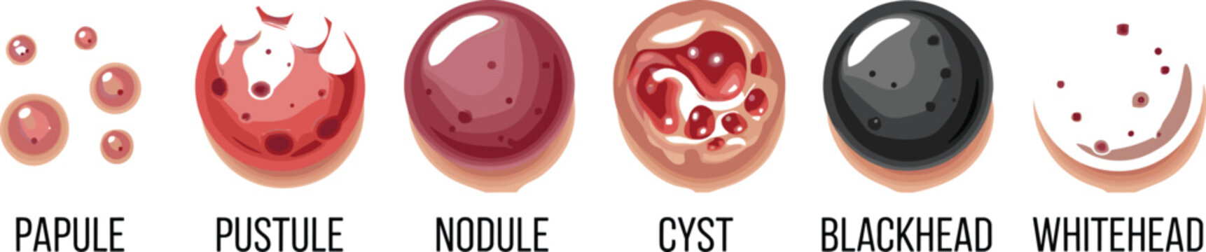 Acne Lesion Types Medical Infographic Vector Showing Papule Pustule Nodule Cyst Blackhead and Whitehead for Dermatology Education and Skincare Awareness