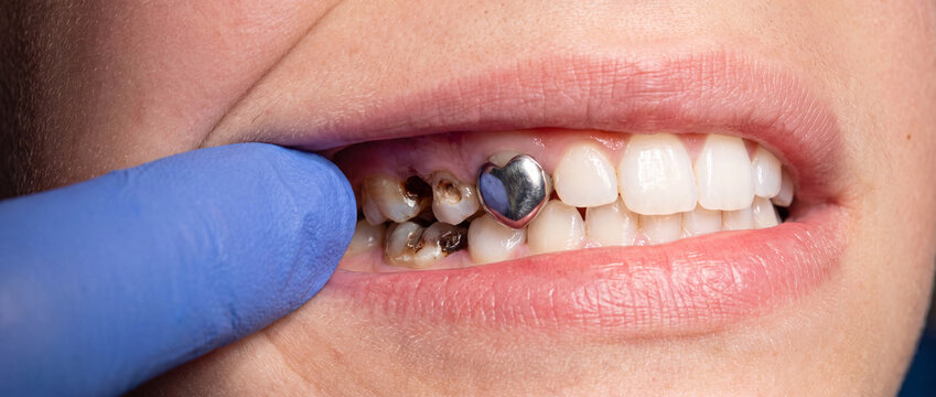 Close up of decayed teeth with heart shaped dental filling with gloved finger pointing teeth person mouth decayed dental hygiene tooth decay person s restoration