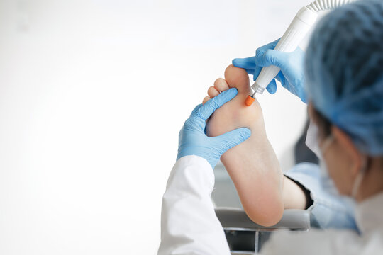 Podiatrist performing foot treatment on patient in medical clinic setting, removal of calluses and corns