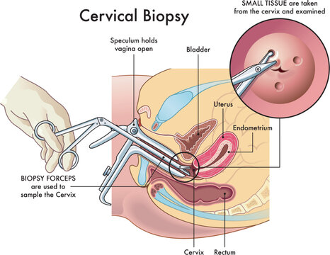 Medical illustration  of the cervical biopsy procedure with annotations.