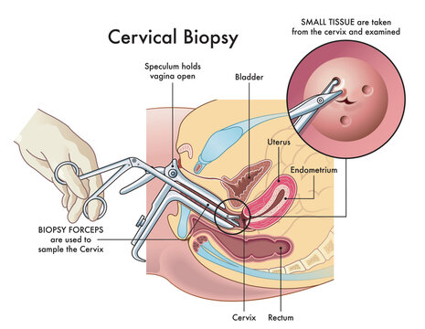 Medical illustration  of the cervical biopsy procedure with annotations.
