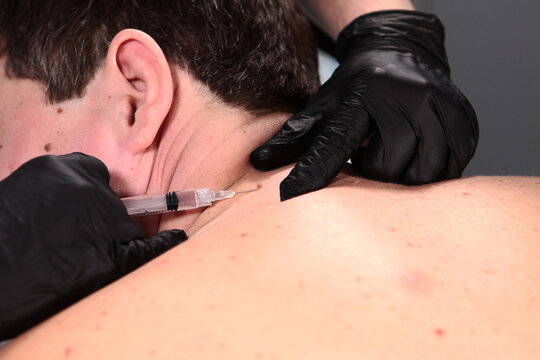 Anesthesia before removal of papillomas on man's body. Men's cosmetology. Close-up