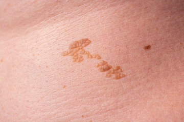 Fototapeta premium Close Up of Raised Skin Lesion