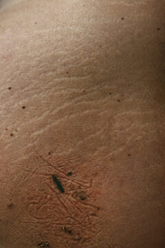 Close Up of Female stretch marks on the Skin Texture 