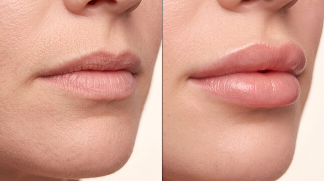 Side by side close up comparison of female lips before and after cosmetic lip filler injection treatment