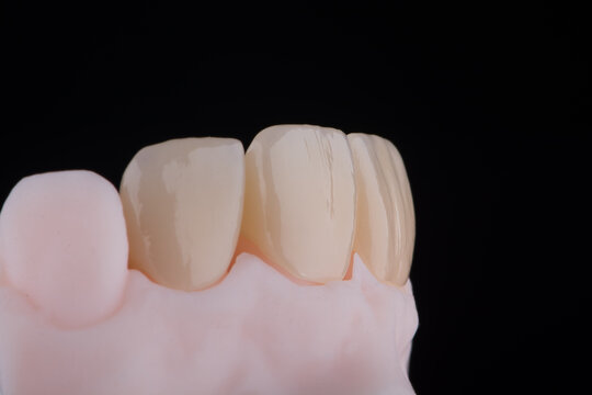 High-quality four dental crowns made of zirconium for fixation to the frontal teeth of upper jaw.