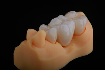 Naturally dental bridge made of zirconium for fixation to upper jaw © gorynvd