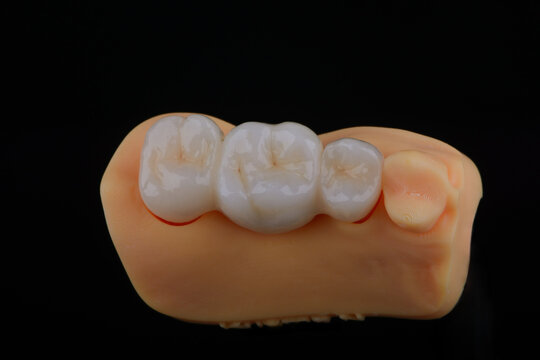 Naturally dental bridge made of zirconium for fixation to upper jaw