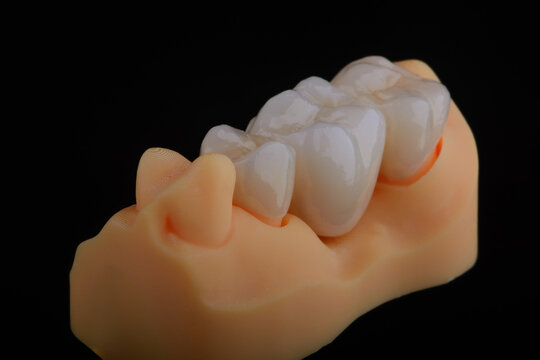 Naturally dental bridge made of zirconium for fixation to upper jaw