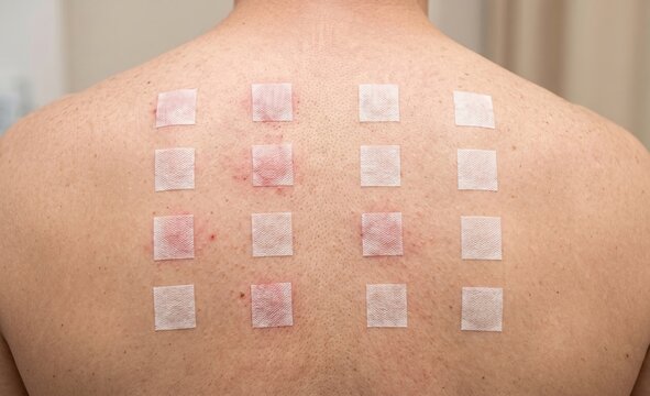 Man patient receiving allergy patch test with multiple square adhesives on his bare back