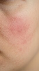 Fototapeta premium Close-up of Skin with Acne and Redness.
