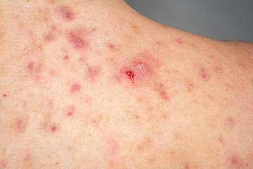 Naklejka premium Acne pimple with infected pore. Acne pimple and bacterial inflammation. Human skin detail, acne pimple. Medical macro, acne pimple problem.