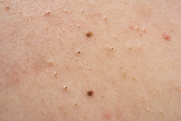 Fototapeta premium Blemishes on acne skin texture. Blemishes with inflamed pimples redness. Blemishes near pores and lesions. Blemishes in dermatology closeup detail.