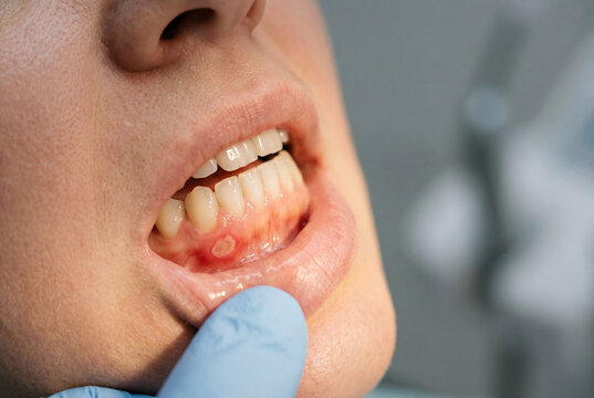 Gloved hand pulling down a lower lip to examine a visible canker sore on the lower front gums