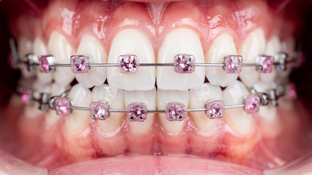 Close-up of perfect white teeth with pink jeweled braces and metal wires, dental care concept for smile makeover, cosmetic dentistry and orthodontic treatment advertising