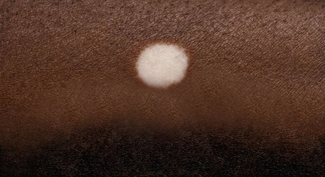 Macule on Fitzpatrick Type VI Skin - Macule in Human Skin &mdash; Macule Plate (69-90)