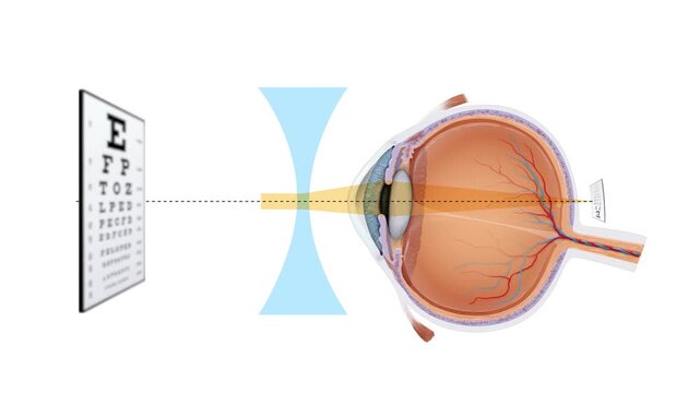 Myopia Eye Correction Medical Animation Nearsighted Vision, Concave Lens Optics, Human Eye Structure, Vision Care, Ophthalmology Training, 2D and 3D Educational Animation