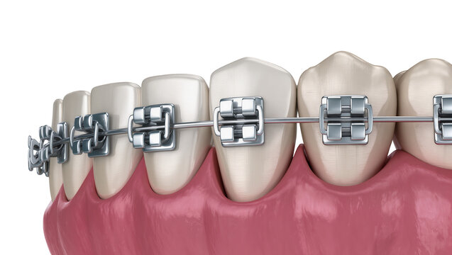 Isolated 3D render of human teeth with metal braces showing orthodontic treatment
