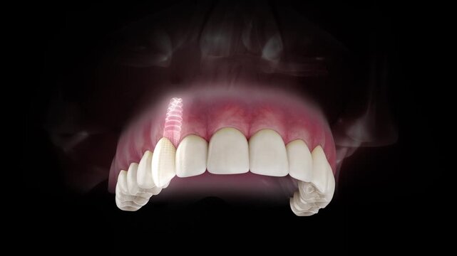 3D visualization of a dental implant of a maxillary canine with a transparent crown and visible gum anatomy on a black background.