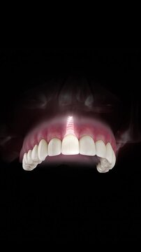 3D visualization of a dental implant of a maxillary central incisor with a transparent crown and visible gum anatomy on a black background.