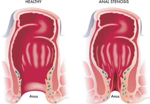 Medical illustration shows a normal anus and one with stenosis