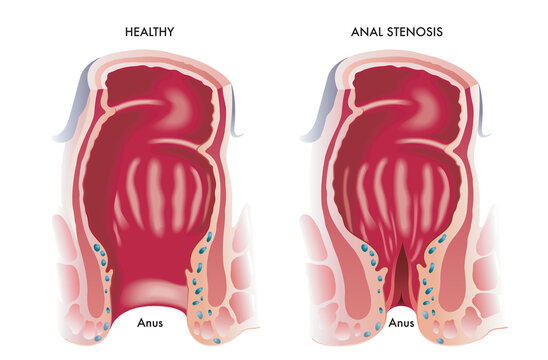 Medical illustration shows a normal anus and one with stenosis
