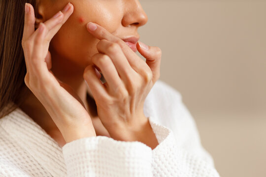 Young woman looks and touches acne pimples on her face skin. Problematic teenage pustule pimply skin on the face. Close up portrait of a girl removing furuncle pustules in the bathroom. 