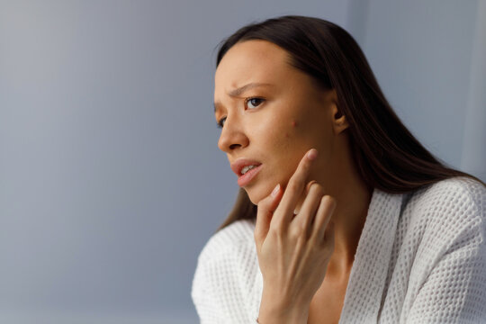 Young upset woman looks and touches acne pimples on her face skin. Problematic teenage pustule pimply skin on the face. 