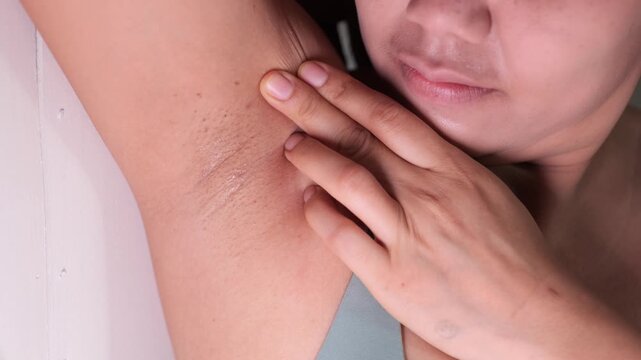 Close-up of Women armpit with problem black armpit. Dark and wrinkle armpit from deodorant allergic.	