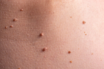 Fototapeta premium Close-up of papillomas on the human body