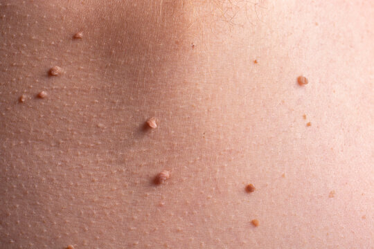 Close-up of papillomas on the human body