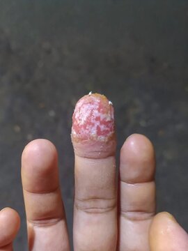 Acrodermatitis continua of Hallopeau showing severe skin and nail lesions