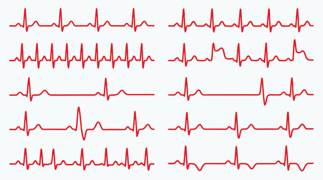 Set of medical heart rate ecg rhythm lines showing different cardiac health conditions vector