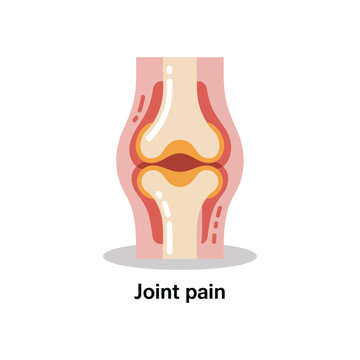 Anatomical of human joint pain showing inflamed cartilage and bone structure for medical education and orthopedic health awareness
