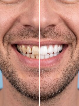 Split portrait of smiling man showing before and after teeth whitening results, highlighting dental care and cosmetic improvement.