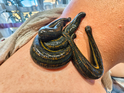 Patient receiving a natural hirudotherapy alternative medicine treatment with medical leeches on the shoulder and neck, using biological therapy for health and wellness.