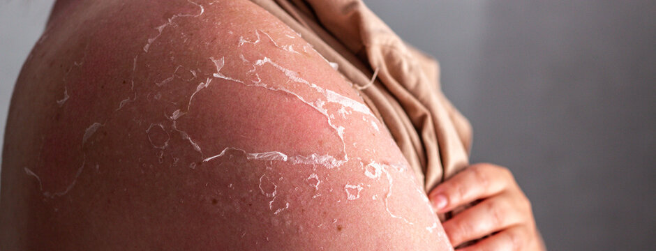 Woman with peeling skin on shoulders after sunburn. Red irritated patches from UV overexposure. Reminder to apply SPF cream and avoid peak sun hours for safety
