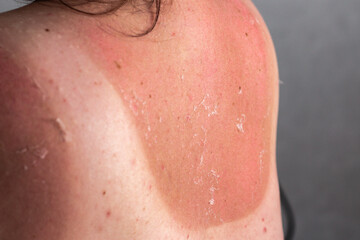 Fototapeta premium Woman with peeling shoulders and back from excessive sun. Skin regeneration after burn. Close up of redness