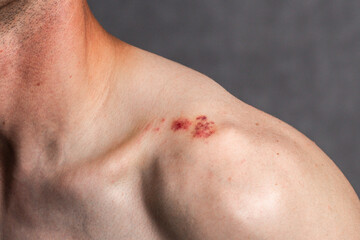 Fototapeta premium Redness and irritation on male shoulder. Red spot with bruises