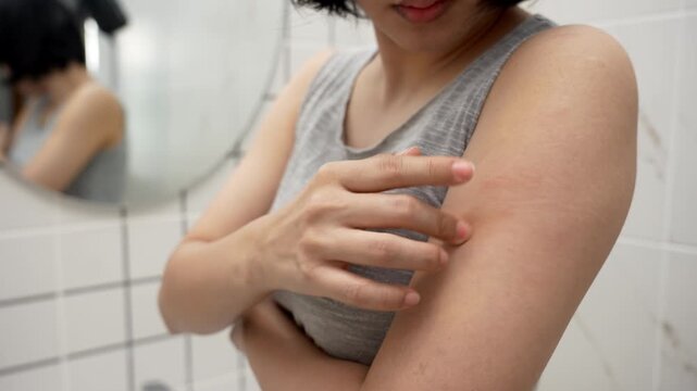 skin problem and beauty. Young woman scratch body has itchy skin from skin allergic, steroid allergy, sensitive skin, red from sunburn, chemical allergy, rash, insect bites, Seborrheic Dermatitis.