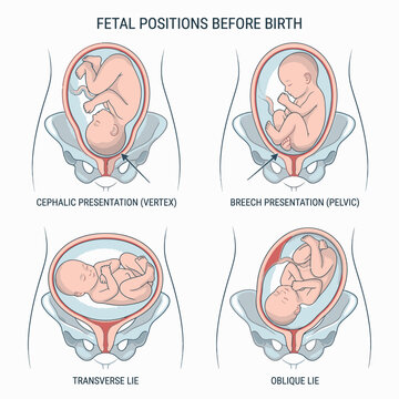 Diagram illustrating four fetal positions before birth: cephalic presentation, breech presentation, transverse lie, and oblique lie