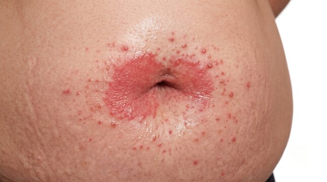 Close up front view of pregnant abdomen navel area with red pruritic papules eruption rash