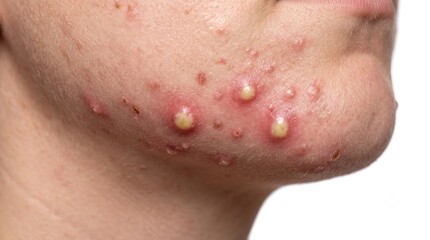 Fototapeta premium Close up of chin with multiple painful inflamed yellow pus filled acne vulgaris pustules